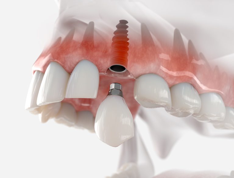 Implantes Convencionales