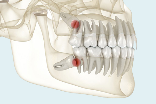 Cirugía Oral y Terceros Molares