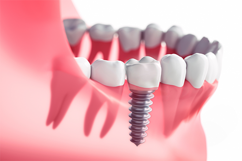 Implante Dental