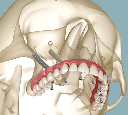 Implantes Pterigoideos y Cigomáticos