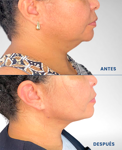 Lipopapada