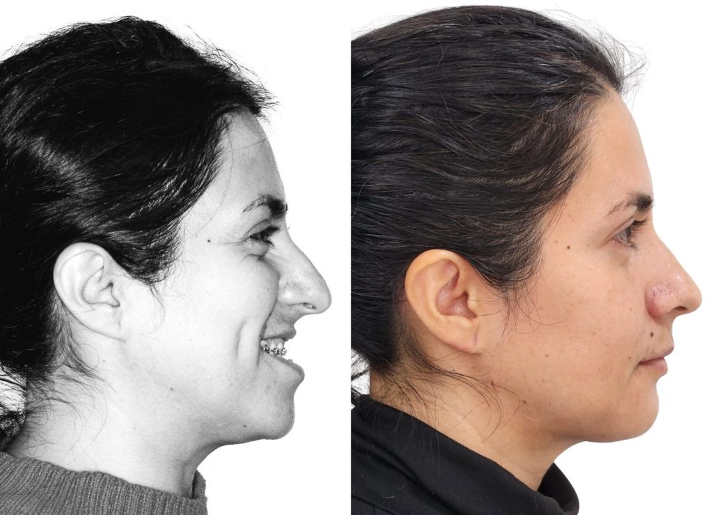 Perfil con mandíbula prominente, maloclusión clase III antes y después de cirugía ortognática