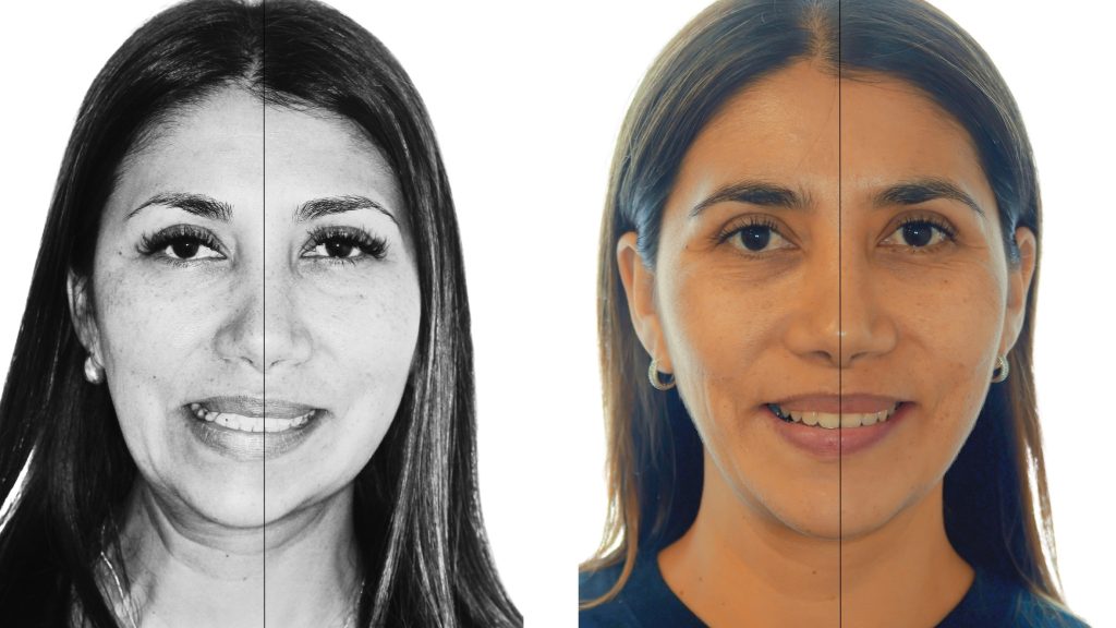 Caso de asimetría facial tratado con cirugía ortognática