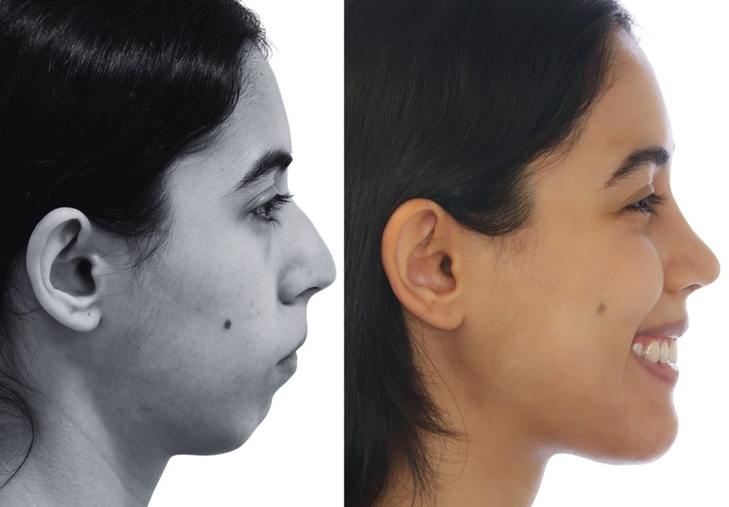 Perfil con mandíbula retraída, maloclusión clase II antes y después de cirugía ortognática