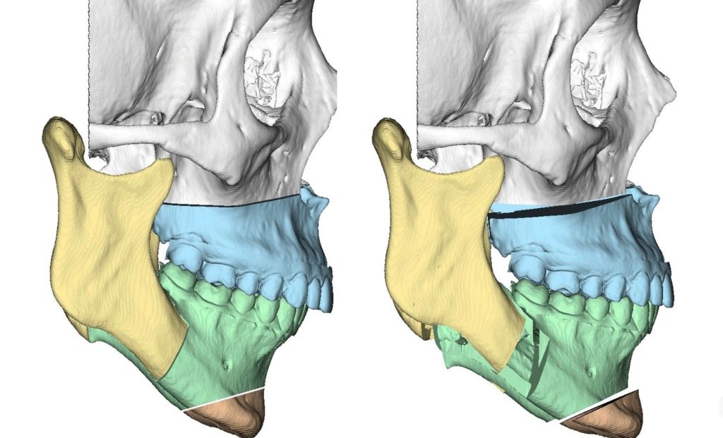 Planificación digital 3D de los maxilares para cirugía ortognática
