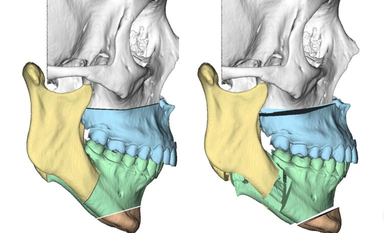 Planificación digital 3D de los maxilares para cirugía ortognática