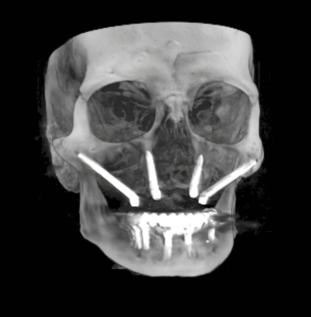 CBCT con 4 implantes cigomaticos e implantes mandibulares