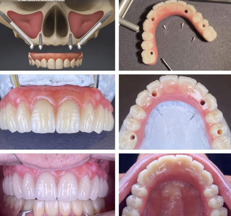 Caso clínico de rehabilitación con implantes cigomáticos