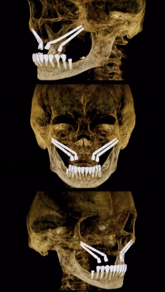 implantes cigomaticos