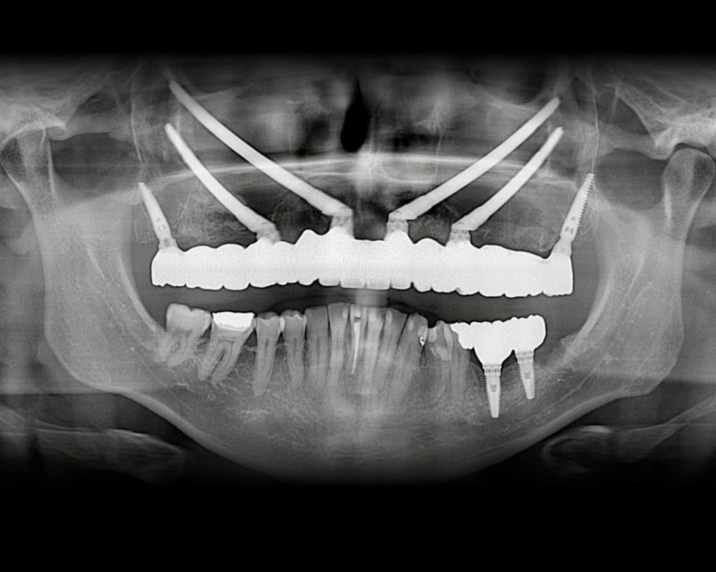 Radiografía de control de implantes cigomáticos