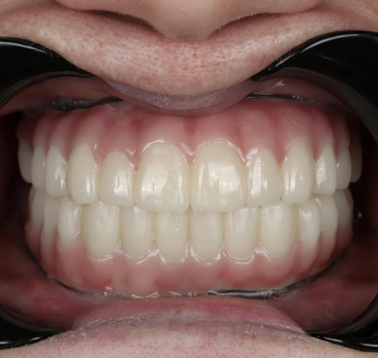 Carga inmediata implantes cigomáticos