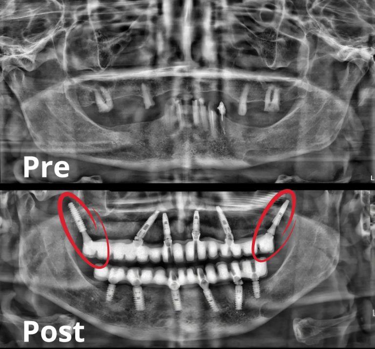 Implantes pterigoideos
