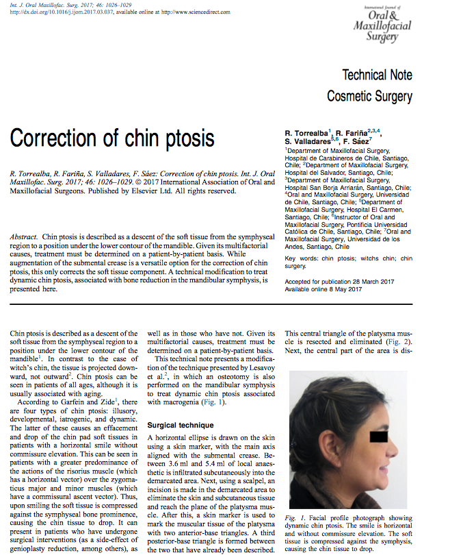 Primera página del artículo Correction of chin ptosis, Int J Oral Maxillofac Surg 2017, Torrealba, Fariña, Valladares y Sáez