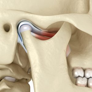 Artrocentesis de la ATM