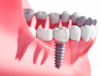 Implante Dental