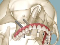 Implantes Pterigoideos y Cigomáticos