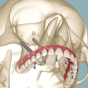 Implantes Pterigoideos y Cigomáticos