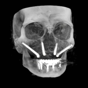 CBCT con 4 implantes cigomaticos e implantes mandibulares